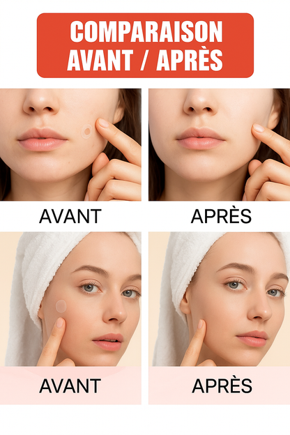 Patch boutons d'acné